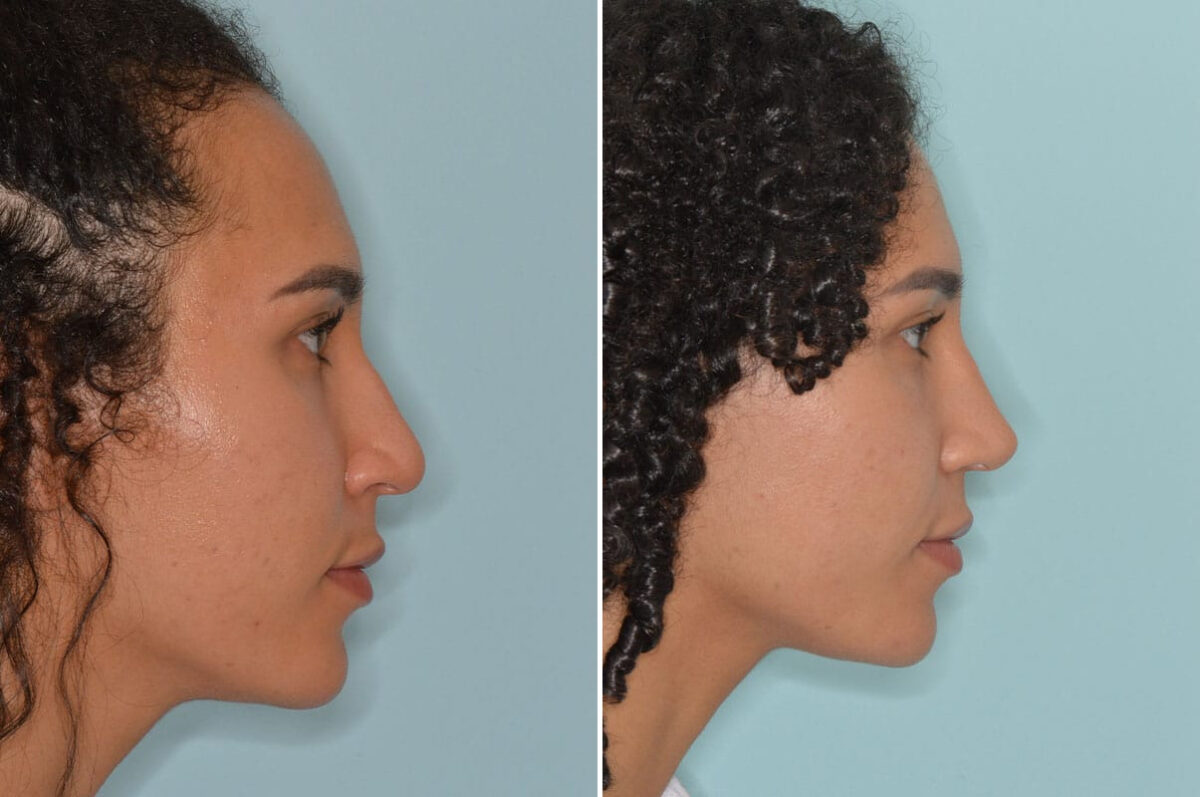 Ethnic Rhinoplasty Before and After Photos in Miami, FL, Patient 8809