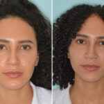 Ethnic Rhinoplasty Before and After Photos in Miami, FL, Patient 8809