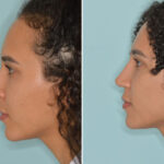 Ethnic Rhinoplasty Before and After Photos in Miami, FL, Patient 8809