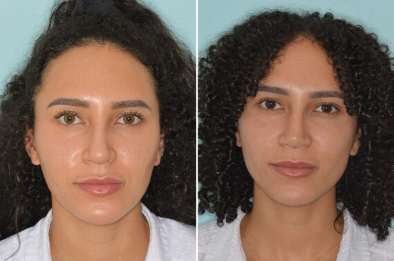 Ethnic Rhinoplasty Before and After Photos in Miami, FL, Patient 8809