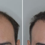 Hair Transplant Before and After Photos in Miami, FL, Patient 8820