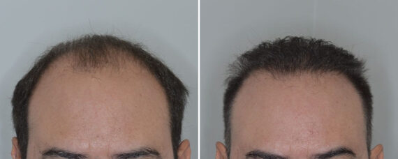 Hair Transplant Before and After Photos in Miami, FL, Patient 8820
