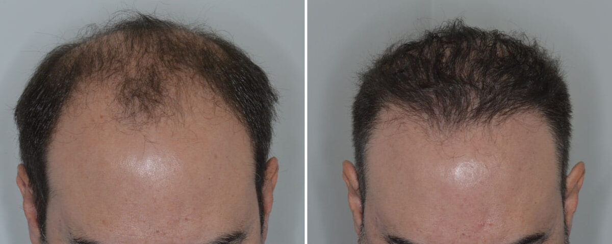 Hair Transplant Before and After Photos in Miami, FL, Patient 8820