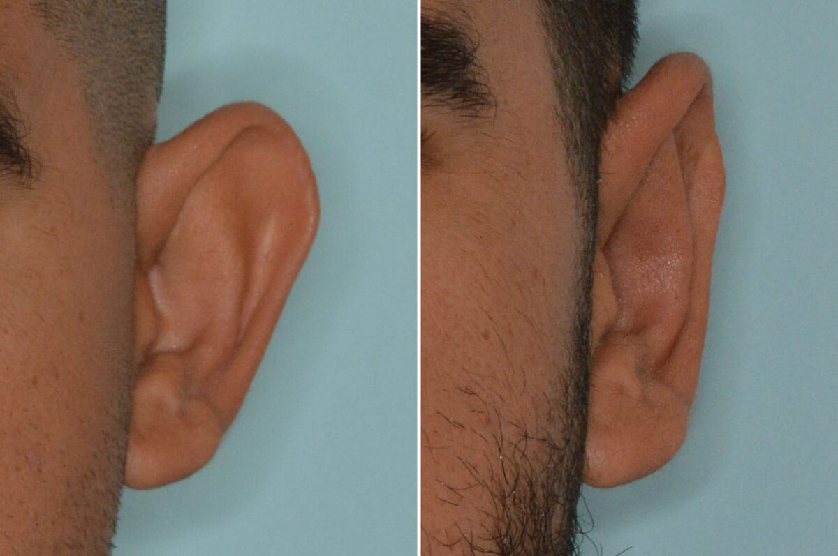 Otoplasty Before and After Photos in Miami, FL, Patient 8829