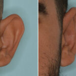 Otoplasty Before and After Photos in Miami, FL, Patient 8829