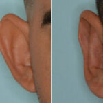 Otoplasty Before and After Photos in Miami, FL, Patient 8829