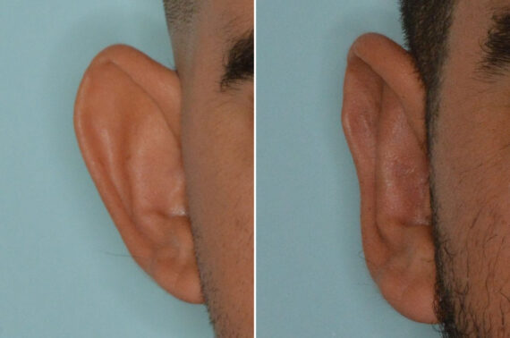Otoplasty Before and After Photos in Miami, FL, Patient 8829