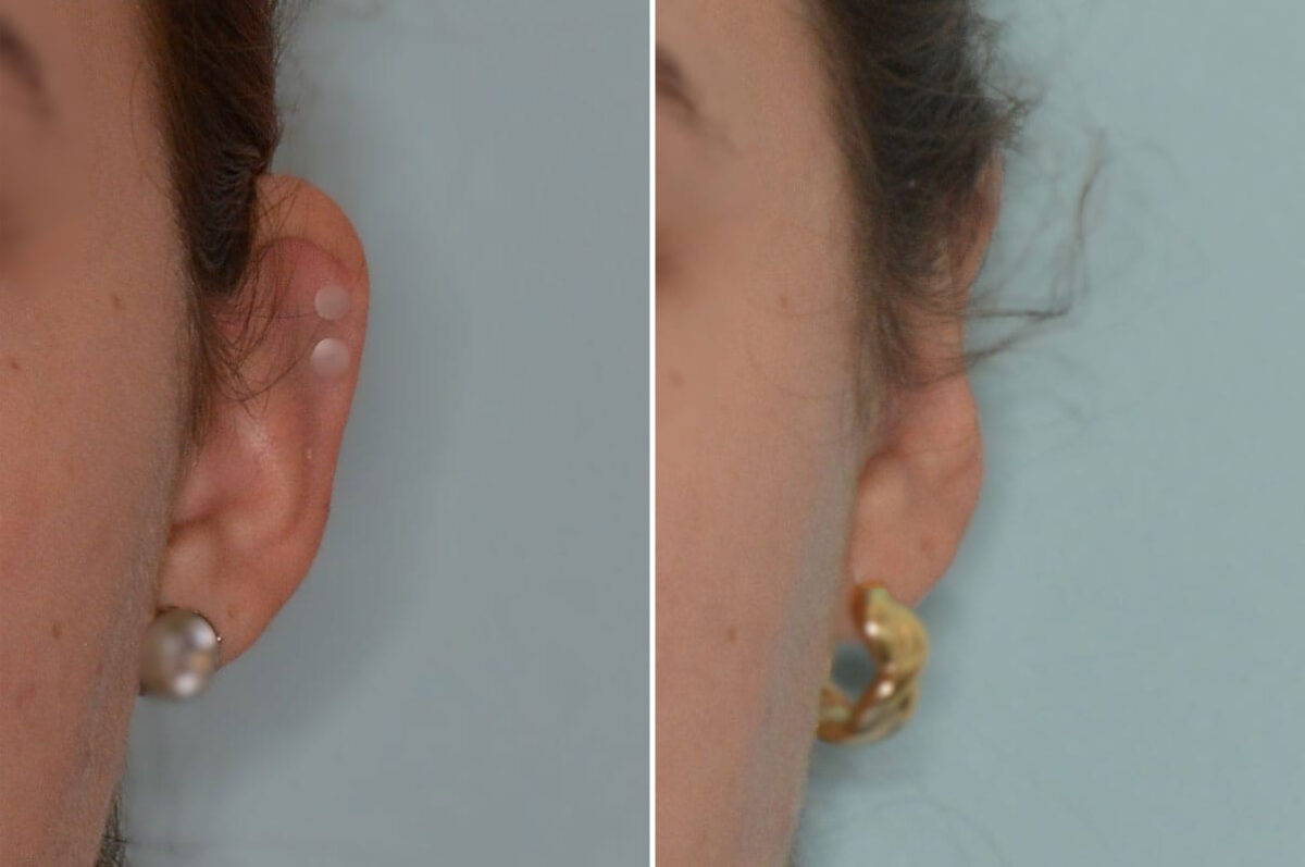 Otoplasty Before and After Photos in Miami, FL, Patient 8836