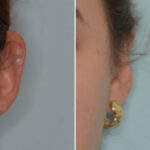 Otoplasty Before and After Photos in Miami, FL, Patient 8836