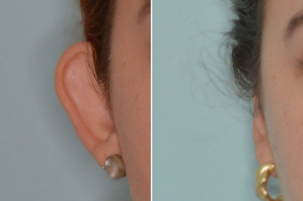Otoplasty Before and After Photos in Miami, FL, Patient 8836