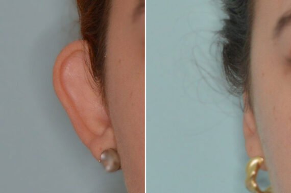 Otoplasty Before and After Photos in Miami, FL, Patient 8836