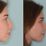 Rhinoplasty Before and After Photos in Miami, FL, Patient 8979