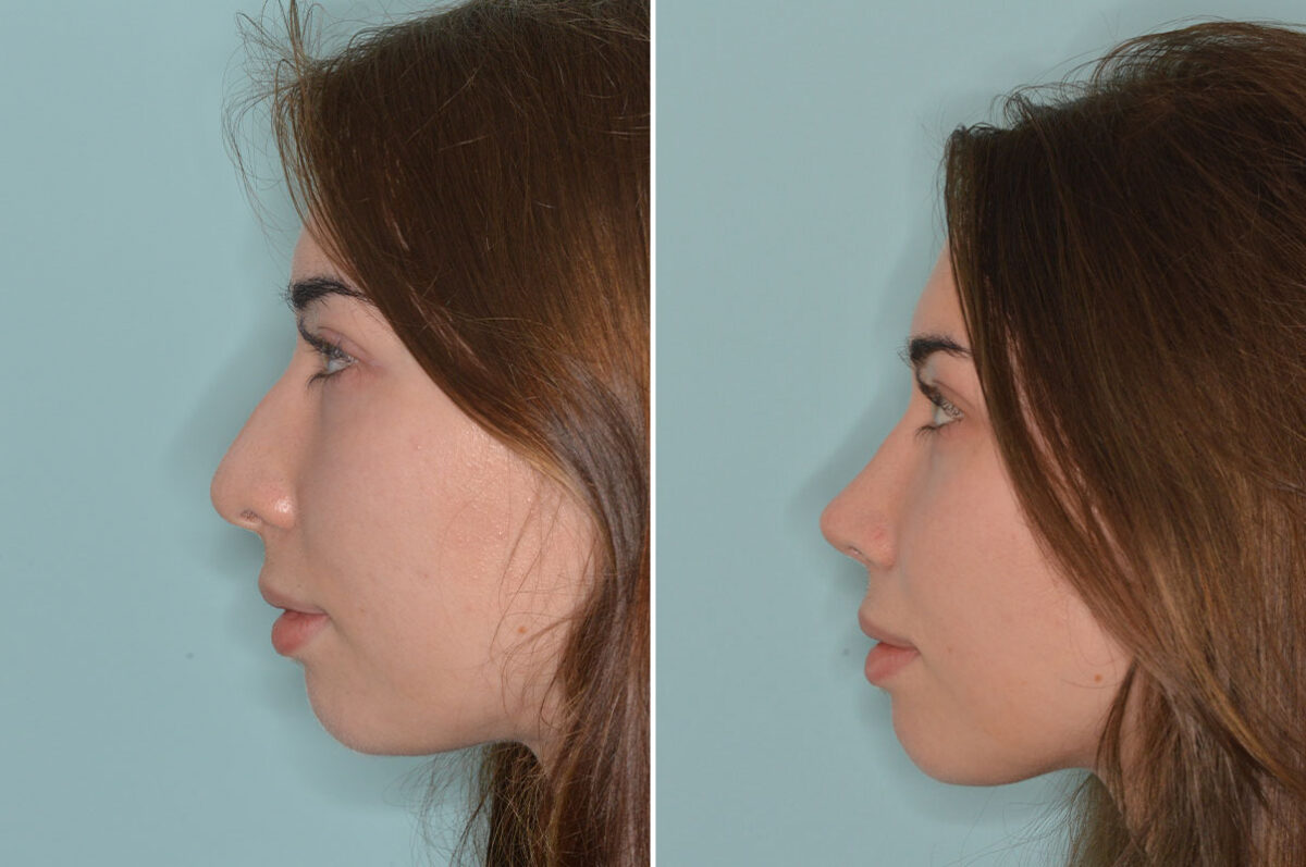 Rhinoplasty Before and After Photos in Miami, FL, Patient 8979