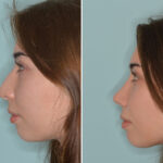 Rhinoplasty Before and After Photos in Miami, FL, Patient 8979
