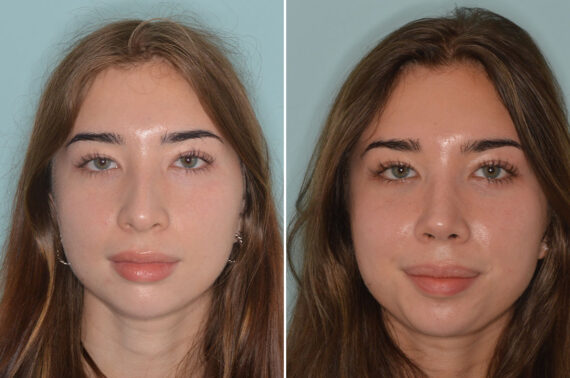 Rhinoplasty Before and After Photos in Miami, FL, Patient 8979