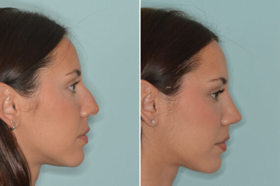 Ethnic Rhinoplasty Before and After Photos in Miami, FL, Patient 8989