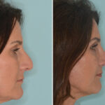 Rhinoplasty Before and After Photos in Miami, FL, Patient 8997
