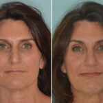 Rhinoplasty Before and After Photos in Miami, FL, Patient 8997