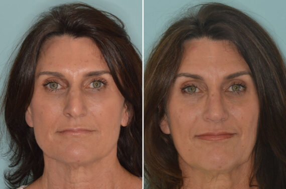 Rhinoplasty Before and After Photos in Miami, FL, Patient 8997