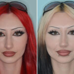 Rhinoplasty Before and After Photos in Miami, FL, Patient 9004