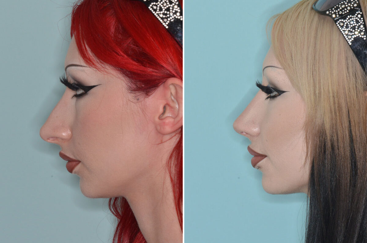 Rhinoplasty Before and After Photos in Miami, FL, Patient 9004