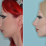 Rhinoplasty Before and After Photos in Miami, FL, Patient 9004