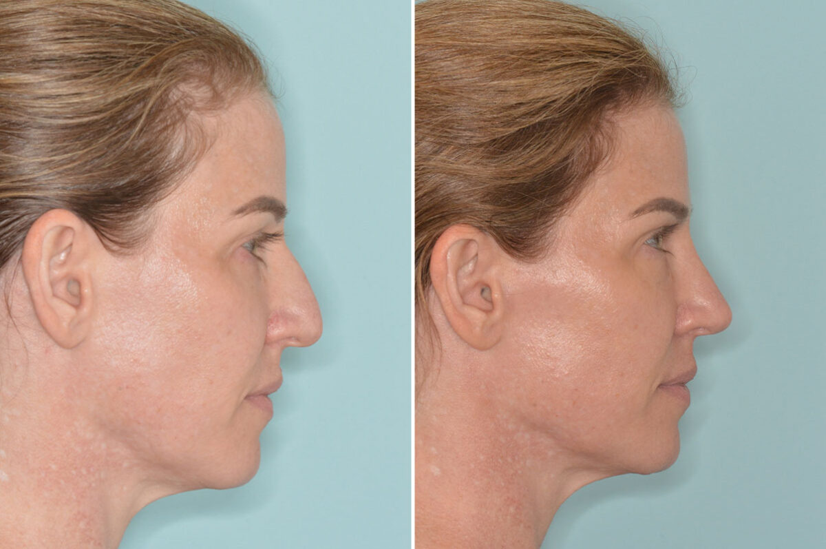 Rhinoplasty Before and After Photos in Miami, FL, Patient 9015