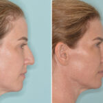 Rhinoplasty Before and After Photos in Miami, FL, Patient 9015