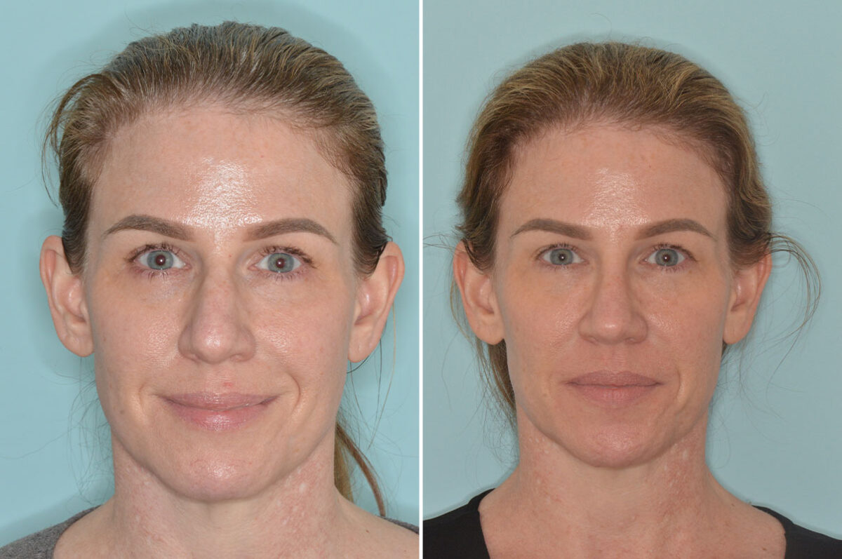 Rhinoplasty Before and After Photos in Miami, FL, Patient 9015