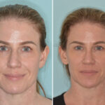 Rhinoplasty Before and After Photos in Miami, FL, Patient 9015