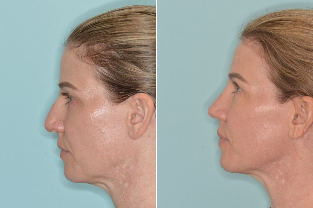 Rhinoplasty Before and After Photos in Miami, FL, Patient 9015
