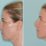 Rhinoplasty Before and After Photos in Miami, FL, Patient 9015