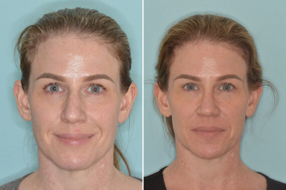 Rhinoplasty Before and After Photos in Miami, FL, Patient 9015