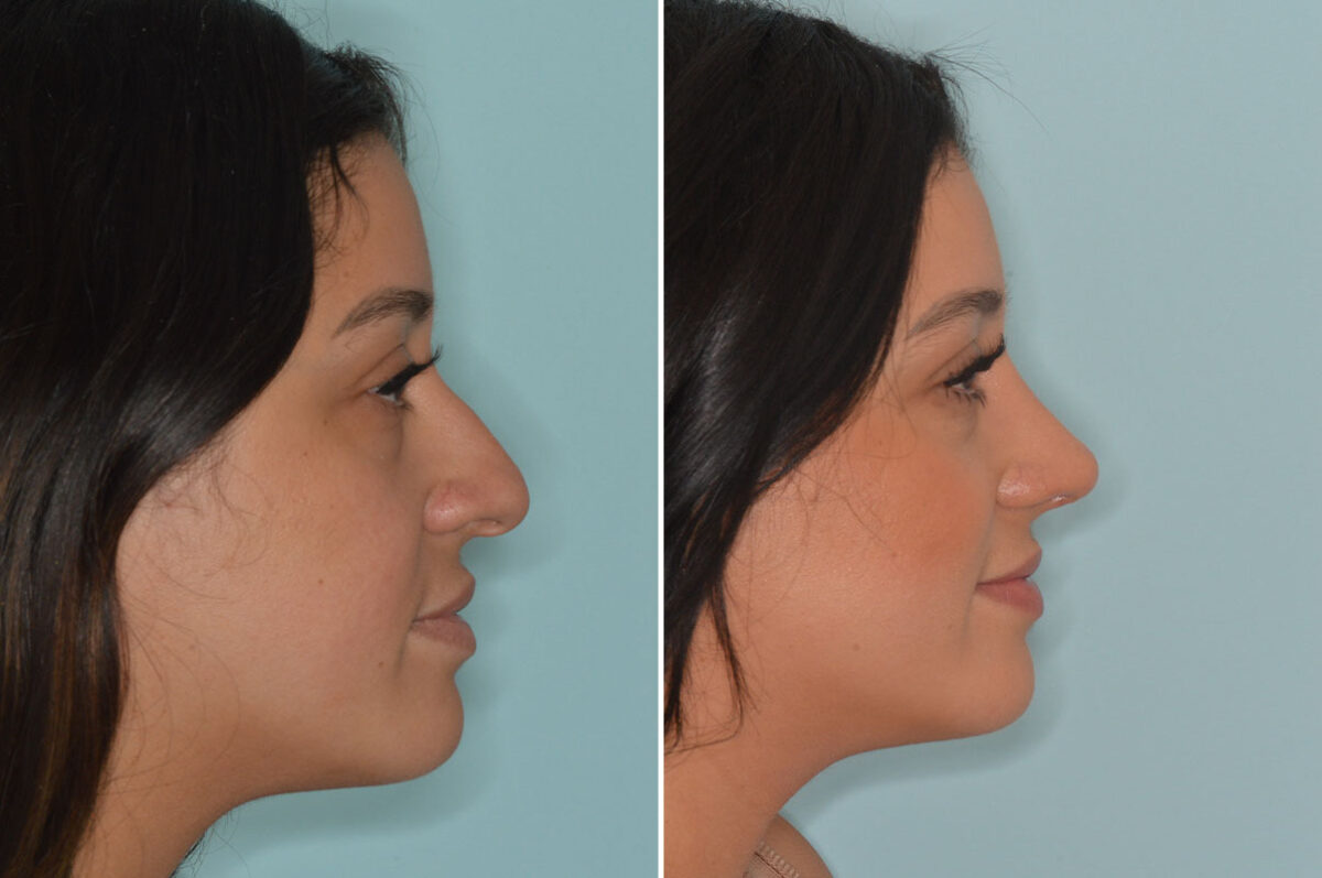 Ethnic Rhinoplasty Before and After Photos in Miami, FL, Patient 9025