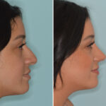 Ethnic Rhinoplasty Before and After Photos in Miami, FL, Patient 9025