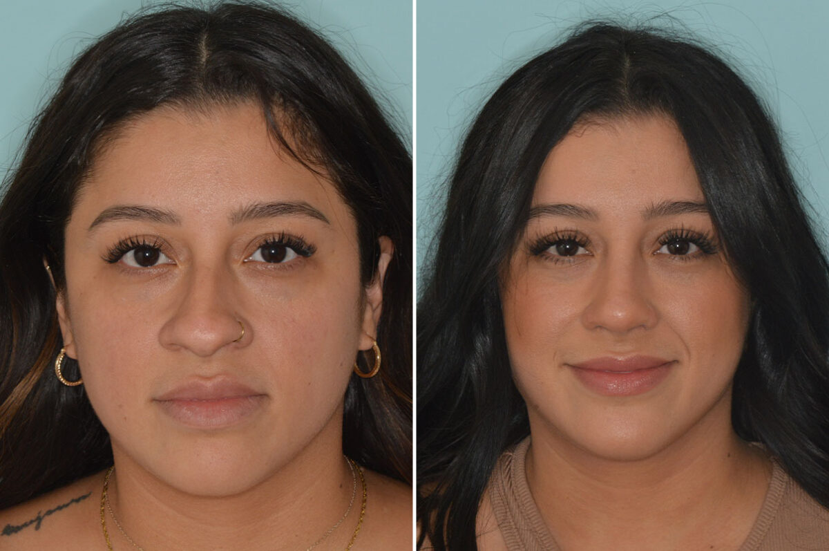 Ethnic Rhinoplasty Before and After Photos in Miami, FL, Patient 9025