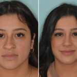 Ethnic Rhinoplasty Before and After Photos in Miami, FL, Patient 9025