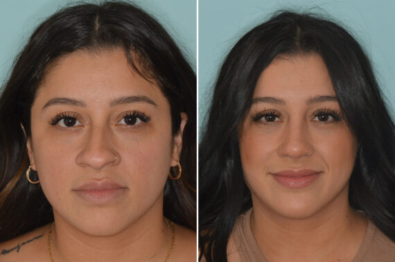 Ethnic Rhinoplasty Before and After Photos in Miami, FL, Patient 9025