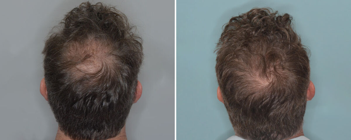 Hair Transplant Before and After Photos in Miami, FL, Patient 9033