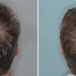 Hair Transplant Before and After Photos in Miami, FL, Patient 9033