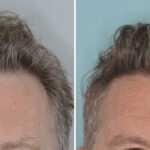 Hair Transplant Before and After Photos in Miami, FL, Patient 9033