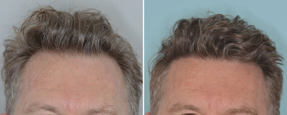 Hair Transplant Before and After Photos in Miami, FL, Patient 9033