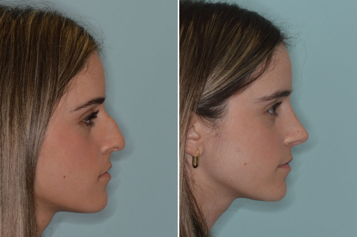 Ethnic Rhinoplasty Before and After Photos in Miami, FL, Patient 9040