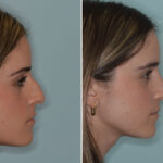 Ethnic Rhinoplasty Before and After Photos in Miami, FL, Patient 9040