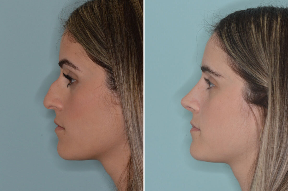 Ethnic Rhinoplasty Before and After Photos in Miami, FL, Patient 9040