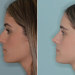Ethnic Rhinoplasty Before and After Photos in Miami, FL, Patient 9040