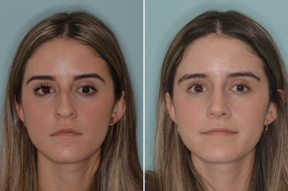 Ethnic Rhinoplasty Before and After Photos in Miami, FL, Patient 9040
