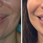 Lip Reduction Before and After Photos in Miami, FL, Patient 9050