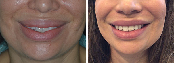 Lip Reduction Before and After Photos in Miami, FL, Patient 9050