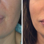 Lip Reduction Before and After Photos in Miami, FL, Patient 9050